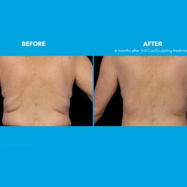 Centro de Estética Coolsculpting